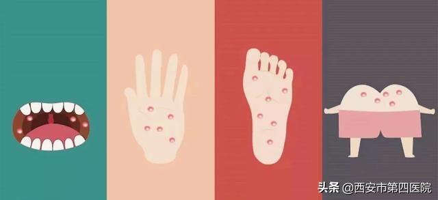 纪夏浮梦|【健康科普】手足口病进入高发季节 做到这些孩子少遭罪