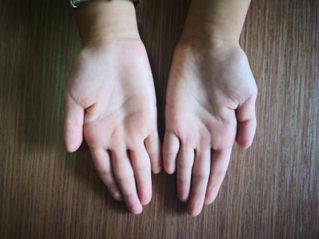 「生活报」8岁女孩患上发病率百万分之一的罕见病
