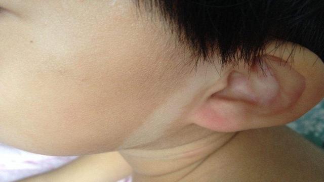 天空的彩虹|准妈孕期避开3件事，可减少胎记形成概率，避免胎记影响孩子成长