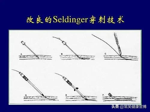 脑血管造影术——诊断脑血管病的“金标准”