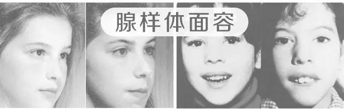 「超级宝妈」砭治腺样体肥大、小儿磨牙