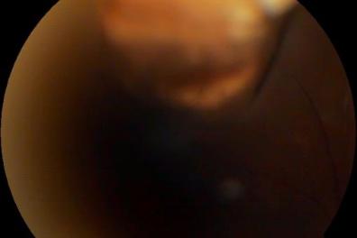 眼科|同济大学附属同济医院眼科为严重眼外伤患