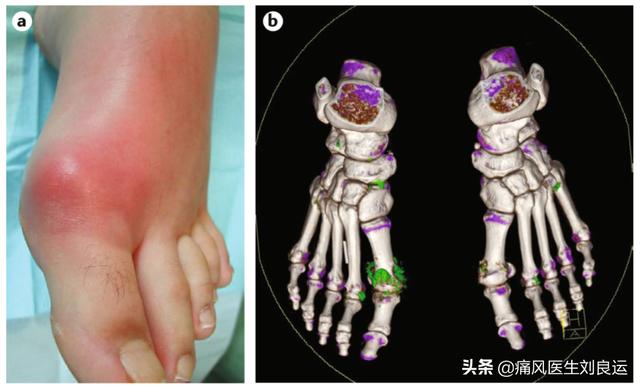 痛风发作后担心长痛风石？做好三件事预防尿酸盐结晶沉积在关节