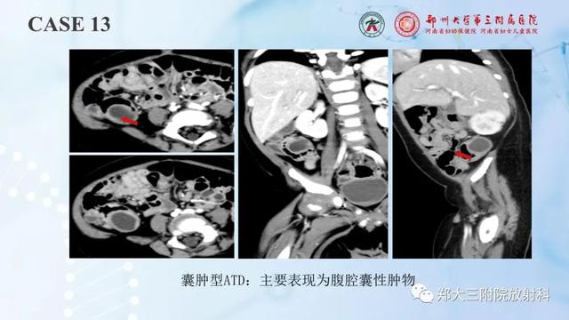 儿童腹部囊性病变诊断思路分析