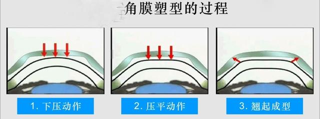 孩子近视加深怎么办？眼科医生教您3种有效控制近视的方法