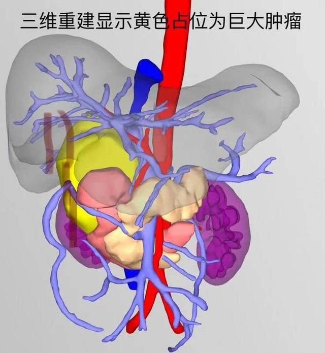 世界级罕见复杂肿瘤，医生冒风险手术六小时成功完整切除