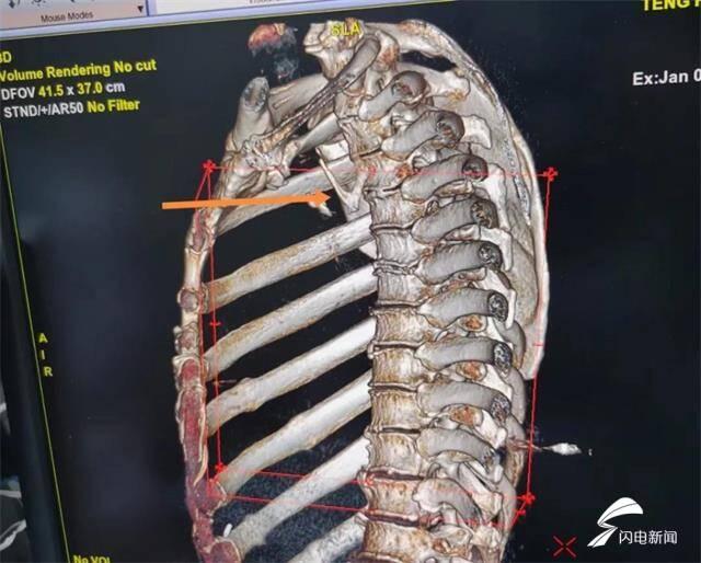 情况危急！V形鸡叉骨卡在食管，威海市中心医院多学科协作成功取骨