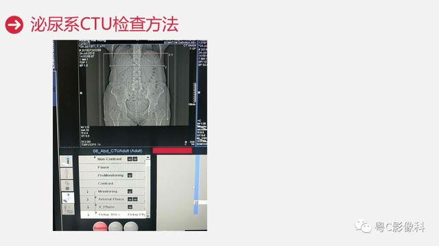 泌尿系CTU扫描技术