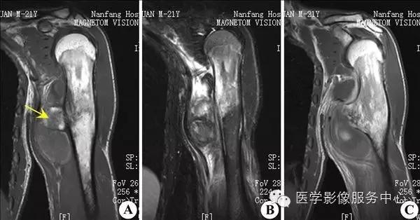 77种骨肌影像病例，助你诊断无忧