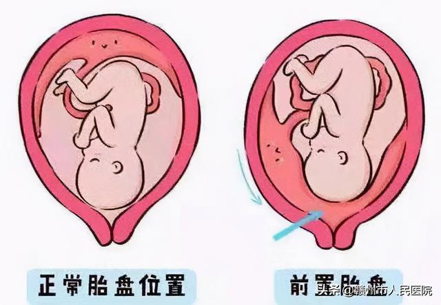 科普丨解除孕妇担心：早孕期超声提示胎盘位置低怎么办