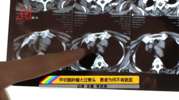 医生|真危险！肿瘤从老人脖子长到胸腔！四分之三以上气管被堵死