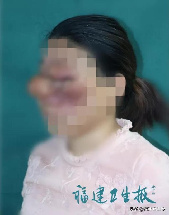 肿物|触目惊心！福建女子脸上顶拳头大肿物30年，接连两次被碰破，满地鲜血