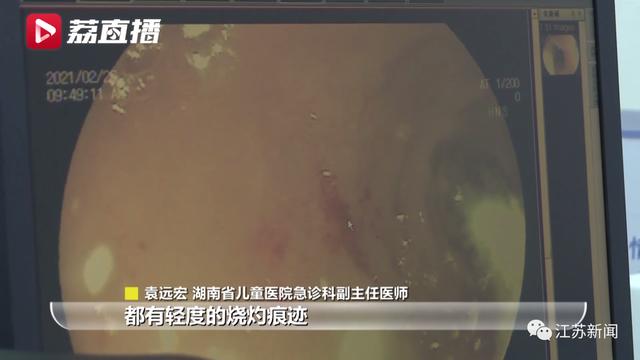 医生|5岁男童胃被灼伤，只因咬了一口……家里的这些东西要收好