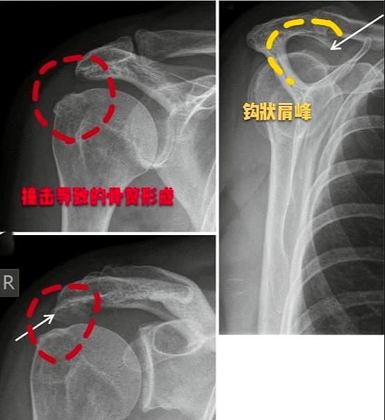 长期肩膀疼痛，反复治疗也不好，问题在哪儿？医生帮您分析下！