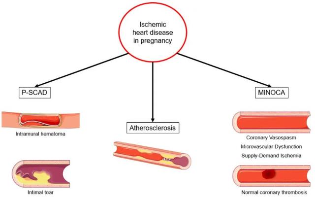 #你的育儿经#进展丨孕期心血管病如何管理，看AHA科学声明怎么说