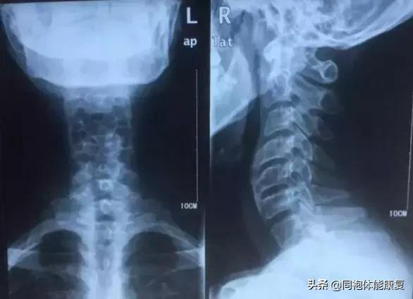 颈椎病|颈椎病—你不可承受之重