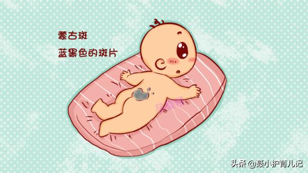 你的育儿经|新生儿屁股淤青怎么回事？如果属于这三种“胎记”记得看医生