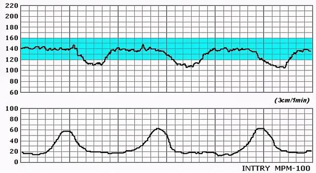 宝妈健康小贴士：怎样做胎心监护更容易过关？准妈妈快收藏