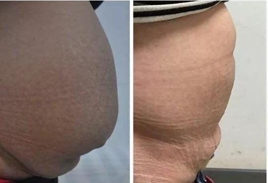 「你的育儿经」健身千问：产后半年了，为什么肚子还是很大？