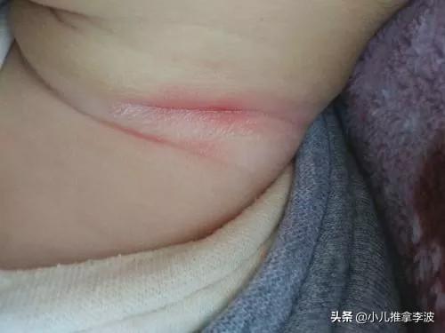 你的育儿经|小儿推拿李波：夏季宝宝淹脖子，发红又破皮怎么办？如何正确护理