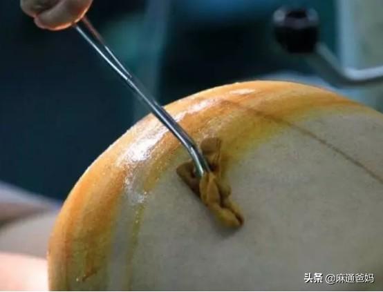 你的育儿经■两次剖腹产都竖切,疼得无法走路,最怕护士来压伤口