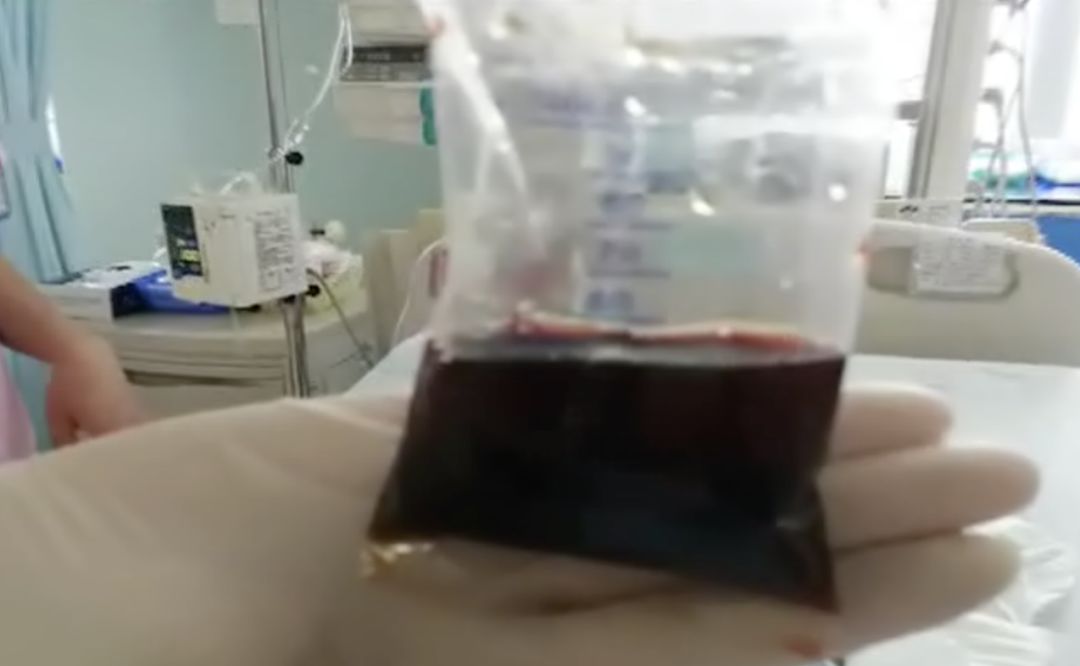 「暖先生格调」3岁宝宝高烧不退，尿尿变成酱油色！爸妈怕被隔离不敢送医，结果……