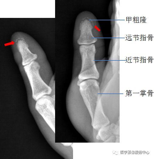 独立值班了 这些骨折你都看出来了吗（附注解）