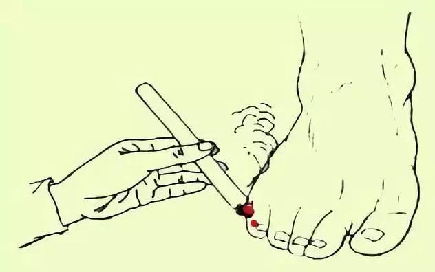 你的育儿经@小儿推拿,一症一穴