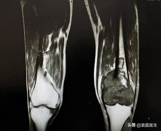 骨梗死部位出现骨肉瘤