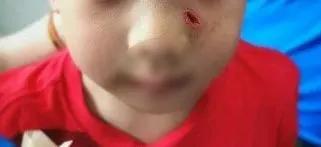 亲亲一家人|后悔！3岁男娃被鸡抓烂脸，伤口“长出”鸡趾甲