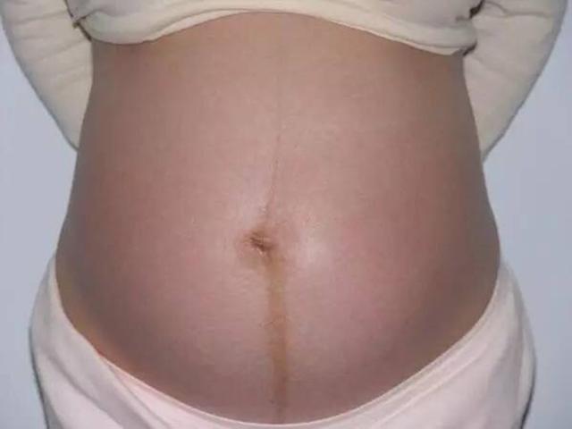 超级宝妈▲怀孕为什么准妈肚子上会“长毛”?老人说是生男宝,果真如此吗?