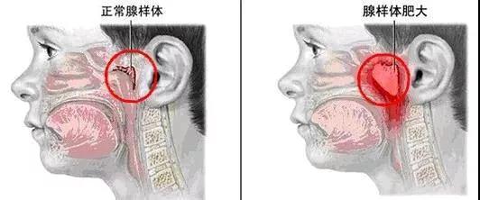 #你的育儿经#宝宝打鼾不是睡得香！严重可能要手术治疗！
