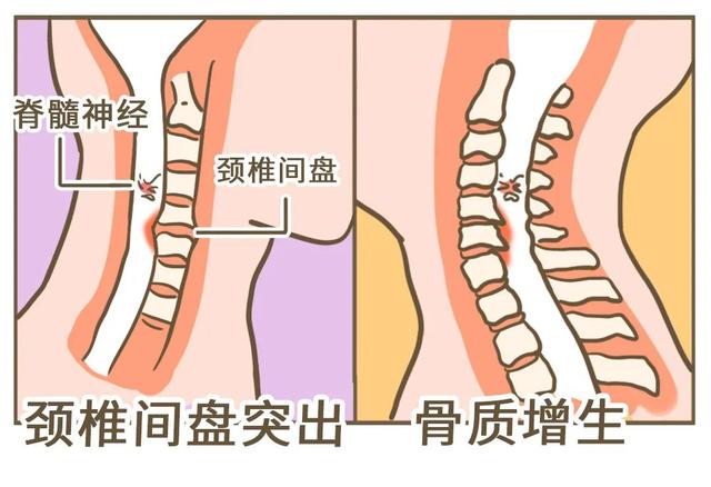 肌肉|落枕可能是身体的“求救信号”，你收到了吗？