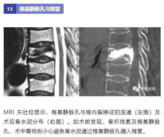 影像经验！脊柱的 13 个影像学特征