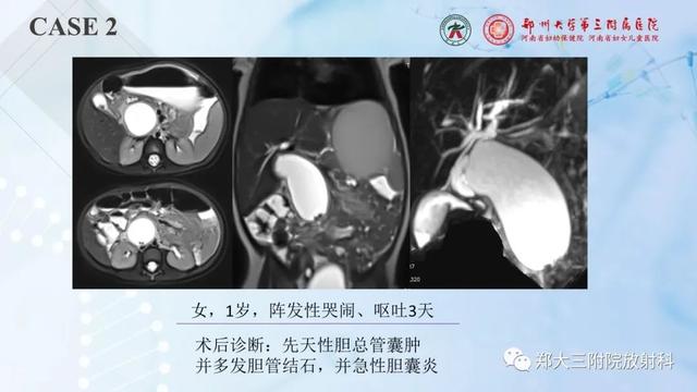 儿童腹部囊性病变诊断思路分析