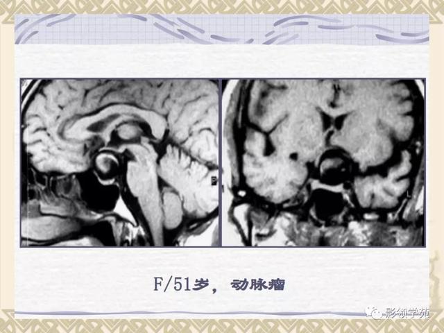 垂体病变的MRI诊断