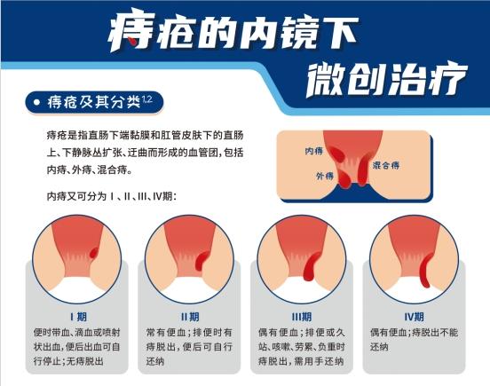 治疗|苏大附一院消化内科开展内镜下内痔微创治疗新技术