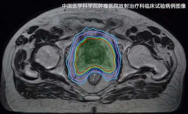 抗癌效果显著！国内正式引入抗癌“导弹”，能追着肿瘤精准打击