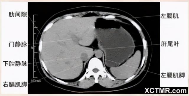 影像解剖：胸、腹部、盆腔CT解剖