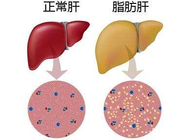 脂肪肝不重视，后果会很严重