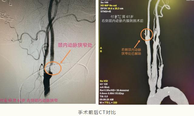 仁心仁术 勇攀高峰——我院神经外科完成颈内动脉内膜剥脱术