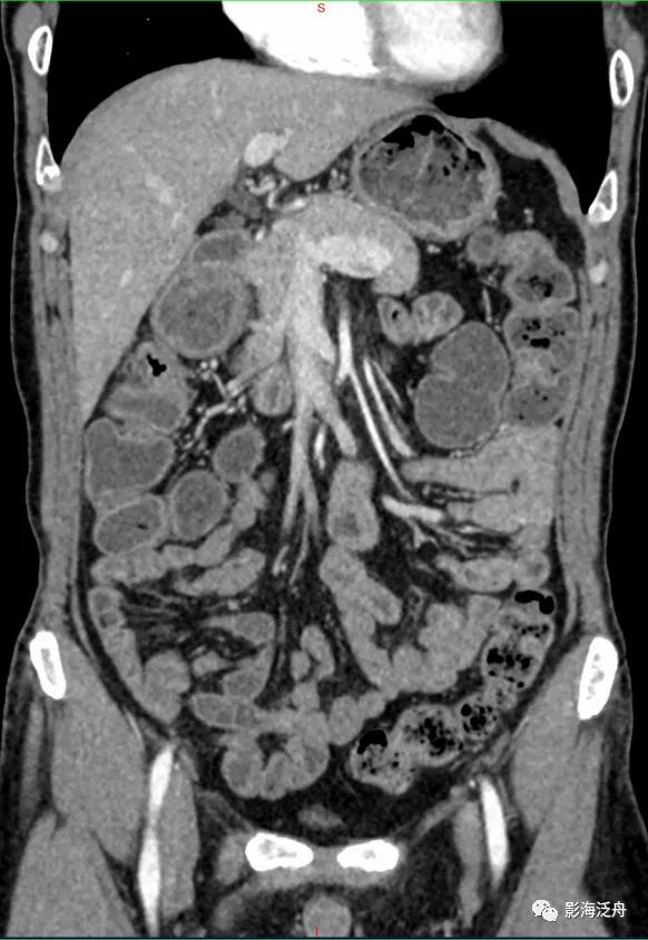 这个病，腹部CT经常会漏诊
