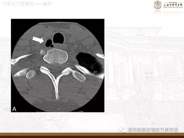 遇到气管、支气管憩室莫惊慌