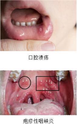 手足|重症患儿增多！福州医生紧急提醒