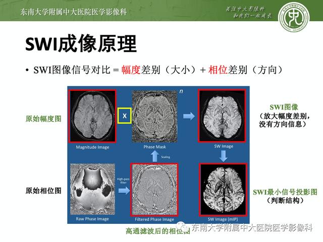 SWI的成像原理及相关病例随访