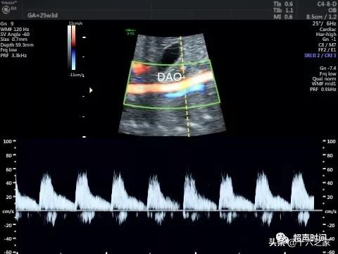 你的育儿经|胎儿下腔静脉缺如