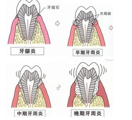 有了这些症状，要小心牙周炎了，小心引发牙疼直接导致牙齿松动