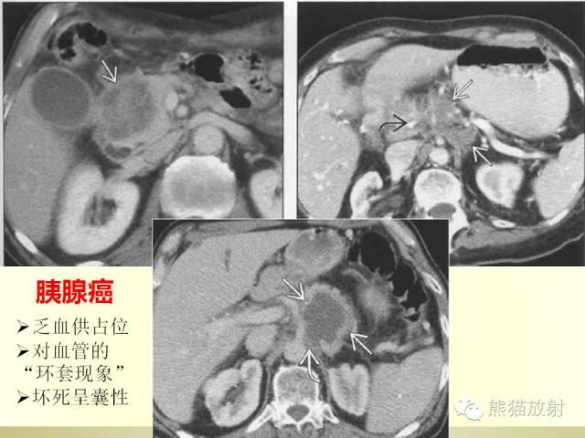 胰腺CT增强扫描、血管评价及病变诊断