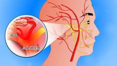 三叉神经|辟谣：牙疼不是病？不但是病，有些“牙疼”可能还是三叉神经痛！