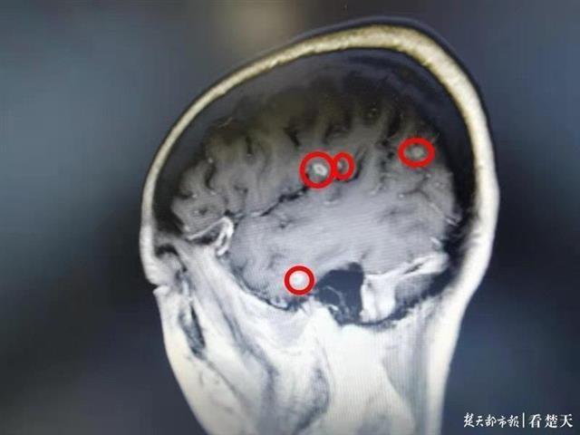 耳鸣患者误信“吃啥补啥”，吃猪耳吃到吐耽搁治疗